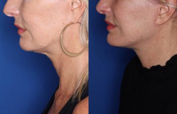 56 year old female 3 months post op from revision facelift performed using KalosLift (Extended Deep Plane Facelift) with platysmaplasty.