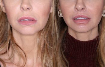 38 year old female 4 months post op from Perialar Lip Lift.