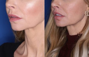 38 year old female 4 months post op from Perialar Lip Lift.