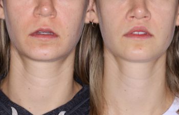 31 year old female 8 months post op from Perialar Lip Lift.