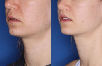 31 year old female 8 months post op from Perialar Lip Lift.