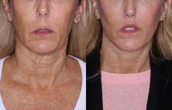 56 year old female 3 months post op from KalosLift & 7 months post op from Perialar Lip Lift.