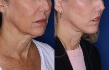 56 year old female 3 months post op from KalosLift & 7 months post op from Perialar Lip Lift.