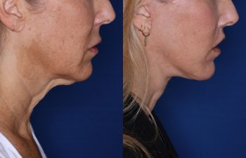 56 year old female 3 months post op from KalosLift & 7 months post op from Perialar Lip Lift.