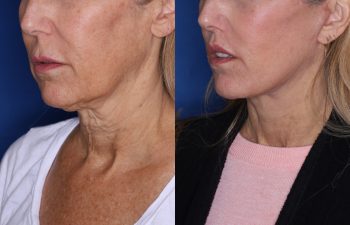 56 year old female 3 months post op from KalosLift & 7 months post op from Perialar Lip Lift.