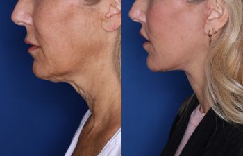 56 year old female 3 months post op from KalosLift & 7 months post op from Perialar Lip Lift.