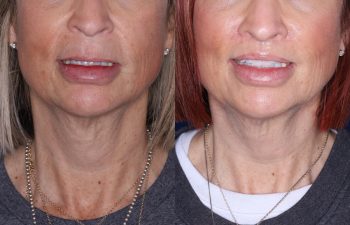 50 year old female 4 months post from Perialar Lip Lift.