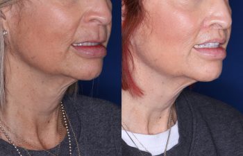 50 year old female 4 months post from Perialar Lip Lift.