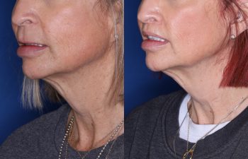 50 year old female 4 months post from Perialar Lip Lift.