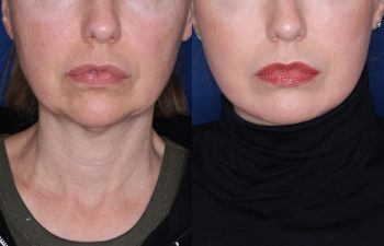 52 year old female 8 months post op from KalosLift (Extended Deep Plane Facelift) with platysmaplasty & buccal fat pad removal.