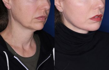 52 year old female 8 months post op from KalosLift (Extended Deep Plane Facelift) with platysmaplasty & buccal fat pad removal.