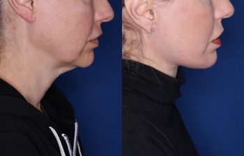 52 year old female 8 months post op from KalosLift (Extended Deep Plane Facelift) with platysmaplasty & buccal fat pad removal.