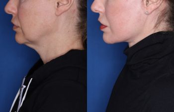 52 year old female 8 months post op from KalosLift (Extended Deep Plane Facelift) with platysmaplasty & buccal fat pad removal.