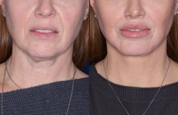 53 year old female 22 months post op from KalosLift (Extended Deep Plane Facelift) with platysmaplasty and Perialar Lip Lift.