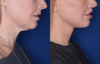 53 year old female 22 months post op from KalosLift (Extended Deep Plane Facelift) with platysmaplasty and Perialar Lip Lift.