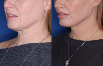 53 year old female 22 months post op from KalosLift (Extended Deep Plane Facelift) with platysmaplasty and Perialar Lip Lift.