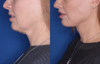 53 year old female 22 months post op from KalosLift (Extended Deep Plane Facelift) with platysmaplasty and Perialar Lip Lift.