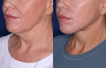 52 year old female 3 months post op from KalosLift (Extended Deep Plane Facelift) with platysmaplasty.