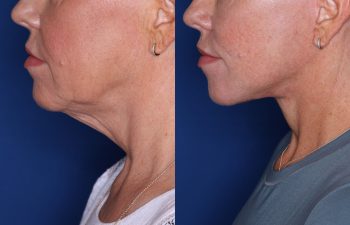 52 year old female 3 months post op from KalosLift (Extended Deep Plane Facelift) with platysmaplasty.