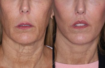 56 year old female 7 months post op from Perialar Lip Lift.