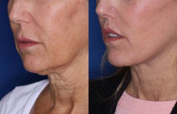 56 year old female 7 months post op from Perialar Lip Lift.