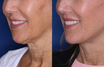 56 year old female 7 months post op from Perialar Lip Lift.