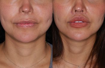 38 year old female 2 months post op from revision lip lift using the Perialar Lip Lift