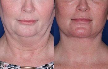 53 year old female 3 months post op from KalosLift (Extended Deep Plane Facelift) with platysmaplasty and buccal fat pad removal.