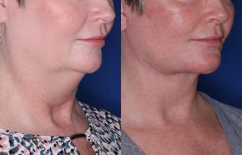 53 year old female 3 months post op from KalosLift (Extended Deep Plane Facelift) with platysmaplasty and buccal fat pad removal.