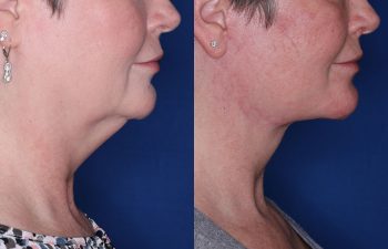 53 year old female 3 months post op from KalosLift (Extended Deep Plane Facelift) with platysmaplasty and buccal fat pad removal.