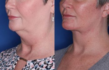 53 year old female 3 months post op from KalosLift (Extended Deep Plane Facelift) with platysmaplasty and buccal fat pad removal.