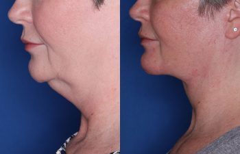 53 year old female 3 months post op from KalosLift (Extended Deep Plane Facelift) with platysmaplasty and buccal fat pad removal.