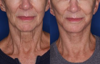 70 year old female 1 month post op from a revision facelift using the KalosLift (Extended Deep Plane Facelift) with platysmaplasty.