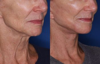 70 year old female 1 month post op from a revision facelift using the KalosLift (Extended Deep Plane Facelift) with platysmaplasty.