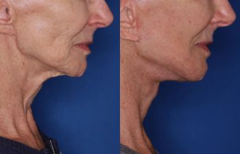 70 year old female 1 month post op from a revision facelift using the KalosLift (Extended Deep Plane Facelift) with platysmaplasty.