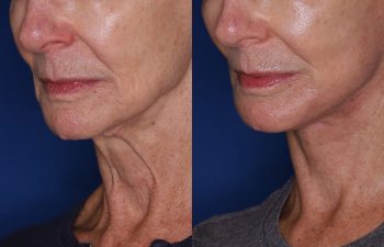 70 year old female 1 month post op from a revision facelift using the KalosLift (Extended Deep Plane Facelift) with platysmaplasty.