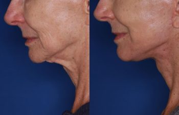 70 year old female 1 month post op from a revision facelift using the KalosLift (Extended Deep Plane Facelift) with platysmaplasty.