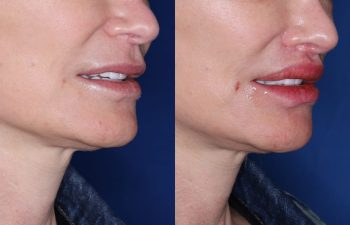 53 year old female 5 months post op from undergoing the Perialar Lip Lift