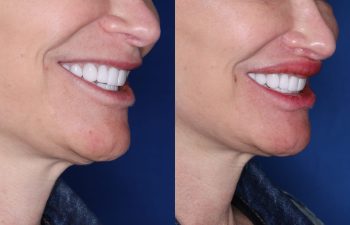 53 year old female 5 months post op from undergoing the Perialar Lip Lift