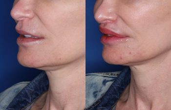 53 year old female 5 months post op from undergoing the Perialar Lip Lift