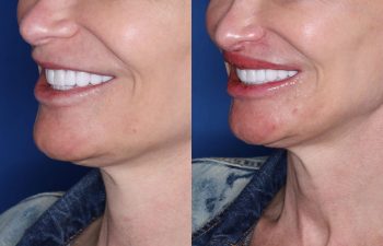 53 year old female 5 months post op from undergoing the Perialar Lip Lift