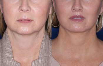 51 year old female 4 months post op from undergoing the KalosLift (Extended Deep Plane Facelift) with platysmaplasty, buccal fat pad removal, and perialar lip lift.