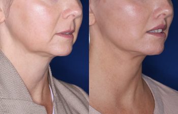 51 year old female 4 months post op from undergoing the KalosLift (Extended Deep Plane Facelift) with platysmaplasty, buccal fat pad removal, and perialar lip lift.