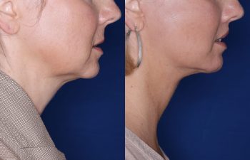 51 year old female 4 months post op from undergoing the KalosLift (Extended Deep Plane Facelift) with platysmaplasty, buccal fat pad removal, and perialar lip lift.