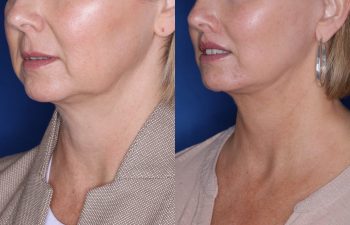 51 year old female 4 months post op from undergoing the KalosLift (Extended Deep Plane Facelift) with platysmaplasty, buccal fat pad removal, and perialar lip lift.