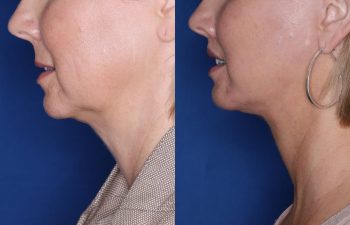 51 year old female 4 months post op from undergoing the KalosLift (Extended Deep Plane Facelift) with platysmaplasty, buccal fat pad removal, and perialar lip lift.