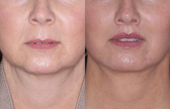 51 year old female 4 months post op from undergoing the Perialar Lip Lift.