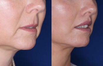 51 year old female 4 months post op from undergoing the Perialar Lip Lift.