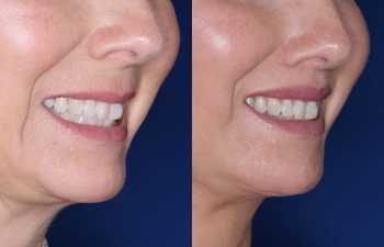 51 year old female 4 months post op from undergoing the Perialar Lip Lift.