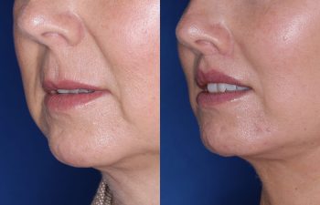 51 year old female 4 months post op from undergoing the Perialar Lip Lift.